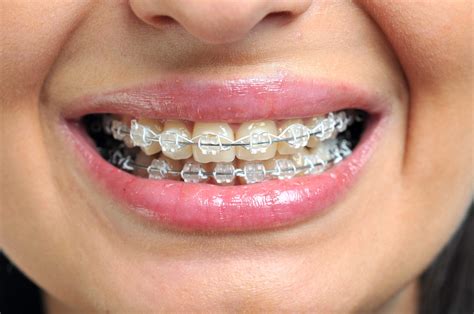 metal bracket on lower teeth how long to keep on|how long for braces to wear.